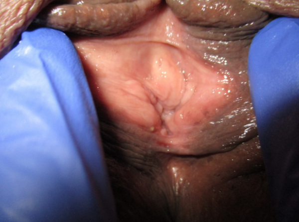 Vaginoplasty Before & After Patient #737