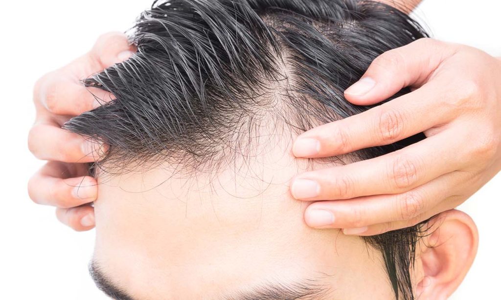 ACP for Hair Regrowth