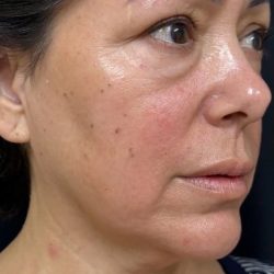 Under Eye PRP (Platelet-Rich Plasma) Before & After Patient #2673