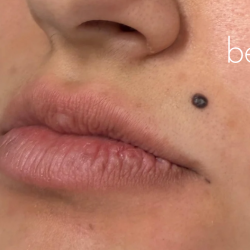 Lip Filler Before & After Patient #2666