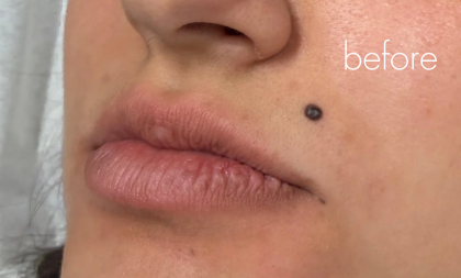 Lip Filler Before & After Patient #2666
