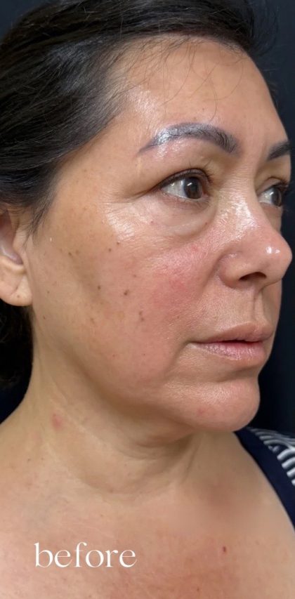 Under Eye PRP (Platelet-Rich Plasma) Before & After Patient #2673