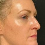 Under Eye PRP (Platelet-Rich Plasma) Before & After Patient #2672