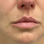 Lip Filler Before & After Patient #2665