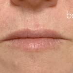 Lip Filler Before & After Patient #2667