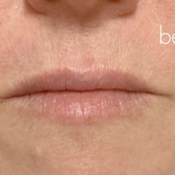 Lip Filler Before & After Patient #2667
