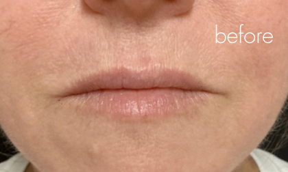 Lip Filler Before & After Patient #2667