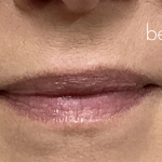Lip Filler Before & After Patient #2668