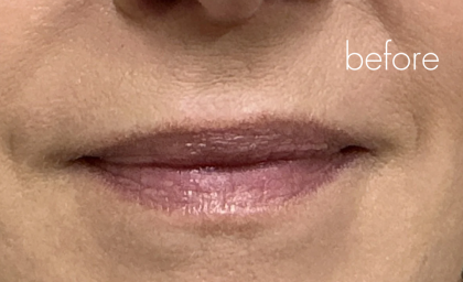 Lip Filler Before & After Patient #2668