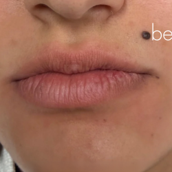 Lip Filler Before & After Patient #2669