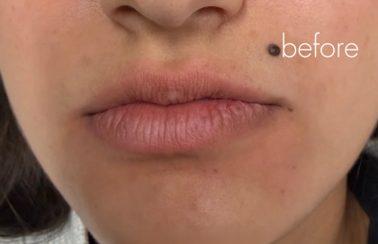 Lip Filler Before & After Patient #2669