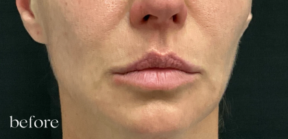 Lip Filler Before & After Patient #2665