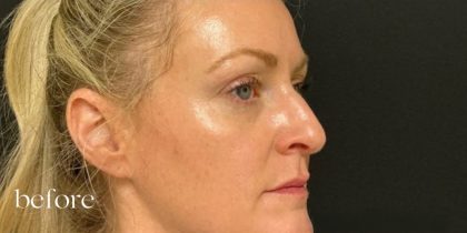 Under Eye PRP (Platelet-Rich Plasma) Before & After Patient #2672