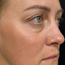 Under Eye PRP (Platelet-Rich Plasma) Before & After Patient #2670