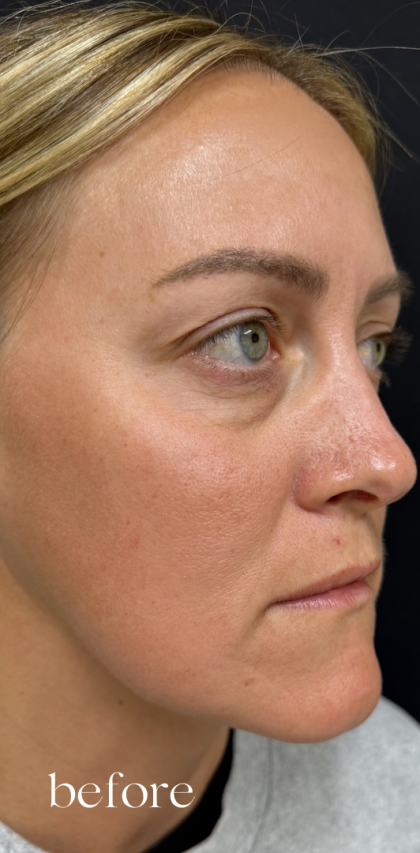 Under Eye PRP (Platelet-Rich Plasma) Before & After Patient #2670