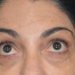 Under Eye PRP (Platelet-Rich Plasma) Before & After Patient #2671