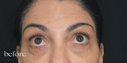 Under Eye PRP (Platelet-Rich Plasma) Before & After Patient #2671