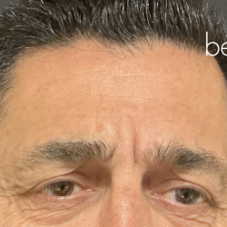 Glabella Botox / Brow Balancing Before & After Patient #2674