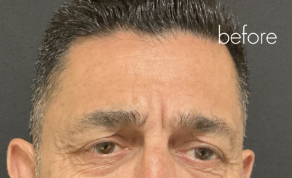 Glabella Botox / Brow Balancing Before & After Patient #2674
