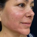 Under Eye PRP (Platelet-Rich Plasma) Before & After Patient #2673
