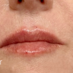 Lip Filler Before & After Patient #2667