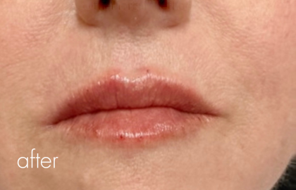 Lip Filler Before & After Patient #2667