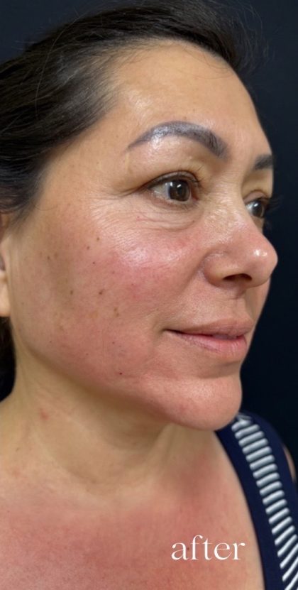 Under Eye PRP (Platelet-Rich Plasma) Before & After Patient #2673