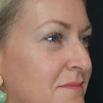 Under Eye PRP (Platelet-Rich Plasma) Before & After Patient #2672