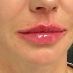 Lip Filler Before & After Patient #2665