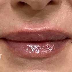 Lip Filler Before & After Patient #2668