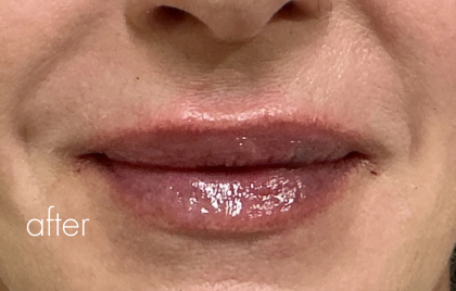Lip Filler Before & After Patient #2668