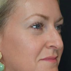 Under Eye PRP (Platelet-Rich Plasma) Before & After Patient #2672