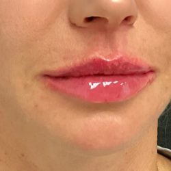 Lip Filler Before & After Patient #2665