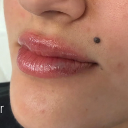 Lip Filler Before & After Patient #2666