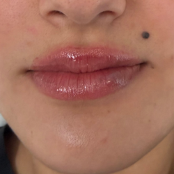 Lip Filler Before & After Patient #2669
