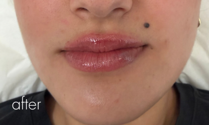 Lip Filler Before & After Patient #2669