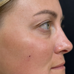 Under Eye PRP (Platelet-Rich Plasma) Before & After Patient #2670
