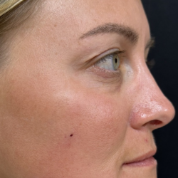 Under Eye PRP (Platelet-Rich Plasma) Before & After Patient #2670