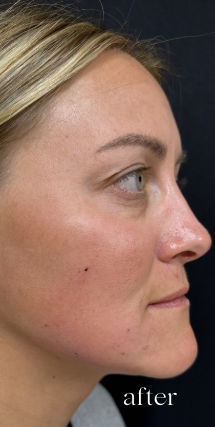 Under Eye PRP (Platelet-Rich Plasma) Before & After Patient #2670