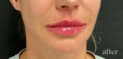 Lip Filler Before & After Patient #2665