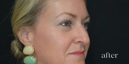 Under Eye PRP (Platelet-Rich Plasma) Before & After Patient #2672