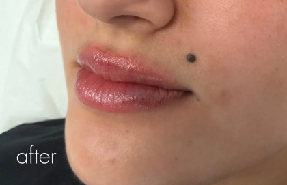 Lip Filler Before & After Patient #2666