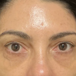 Under Eye PRP (Platelet-Rich Plasma) Before & After Patient #2671