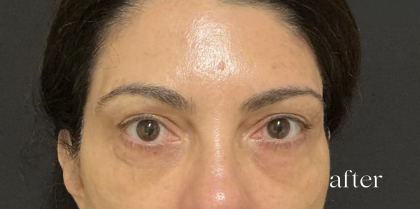Under Eye PRP (Platelet-Rich Plasma) Before & After Patient #2671