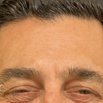 Glabella Botox / Brow Balancing Before & After Patient #2674