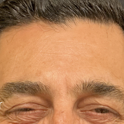Glabella Botox / Brow Balancing Before & After Patient #2674