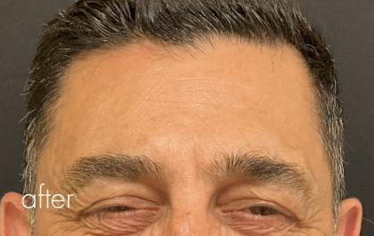 Glabella Botox / Brow Balancing Before & After Patient #2674